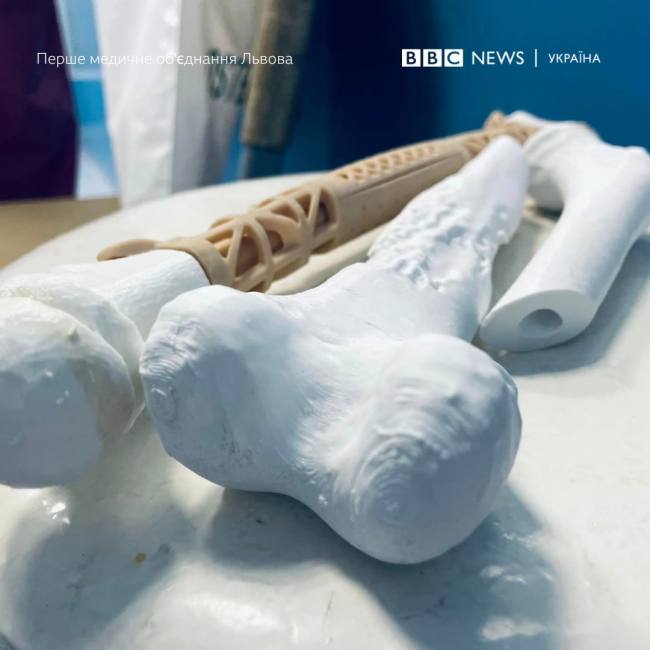 Онкохворому хлопчику пересадили кістку, надруковану на 3D-принтері