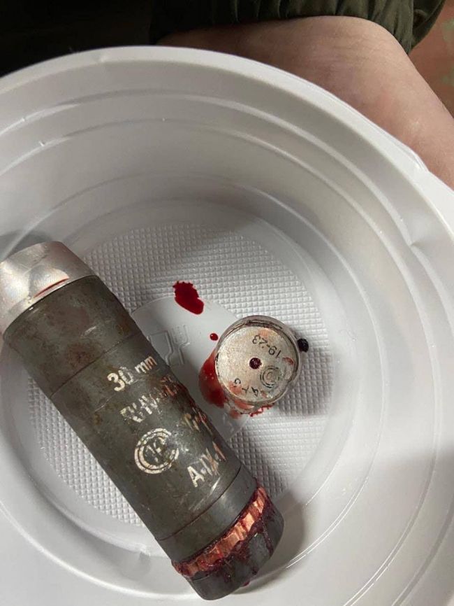 Лікарі витягли бойовий елемент гранати ВОГ-17 з руки українського бійця