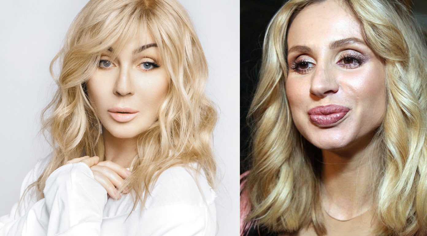 Перекроили лицо, чтобы быть популярными: украинские звезды, которые сделали себе пластику