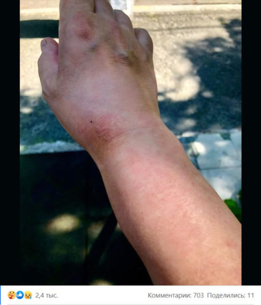 Бывшая жена Пономарева Мозговая показала, как выглядит после продолжительного лечения: руки раздуло