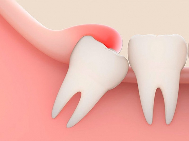 Зубы мудрости: зачем нужны и стоит ли их удалять
