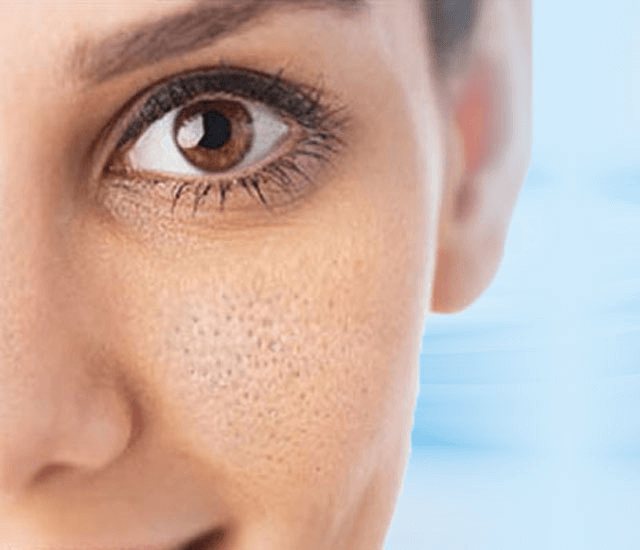 Как сузить расширенные поры и как правильно за ними ухаживать — советует эксперт