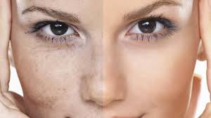 Як стерти з обличчя пігментні плями: що потрібно знати про відбілювання шкіри 