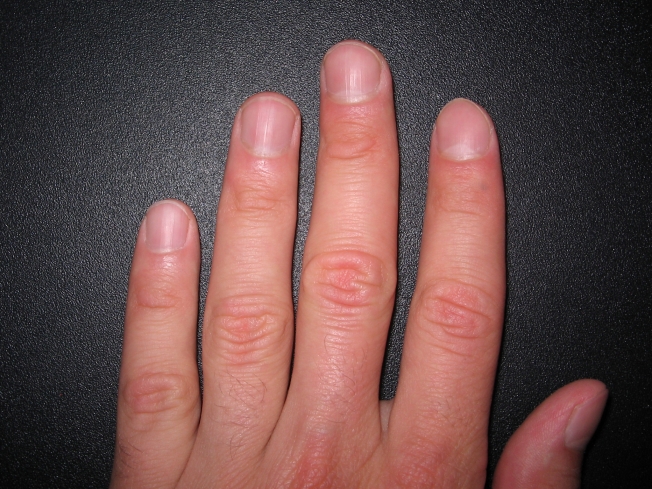 Медики предупредили, как ногти могут выдавать высокий уровень холестерина