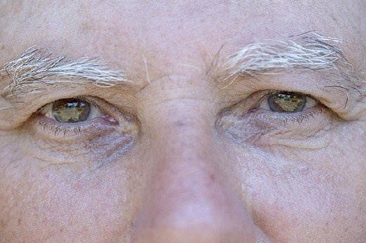 Как определить болезнь Альцгеймера по глазам