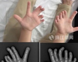 Ребенку с 14 пальцами рук и 13 пальцами ног сделали операцию